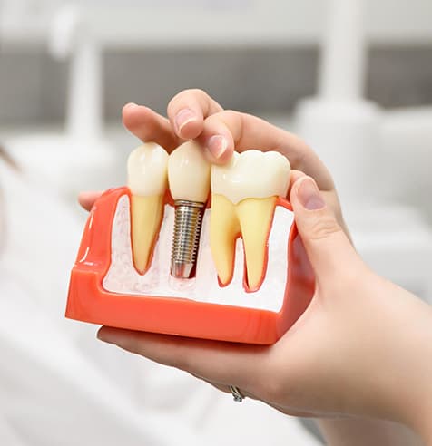 bukal implantes dentales